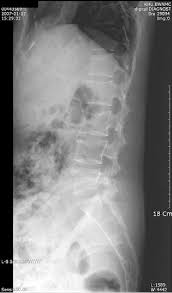 Burst compression fracture of the l1 vertebral body is associated with a 35% loss of vertebral body height. L Spine Lateral X Ray Showed Compression Fracture Of L1 L4 And L5 Download Scientific Diagram