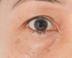 puffy eyes symptoms causes and how