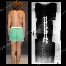 scoliosis in s what to know about