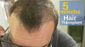 Please be realist is it unsuccessful hair transplant? 5 Months After My Hair Transplant Youtube
