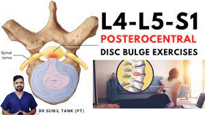 l4 l5 s1 posterocentral disc bulge