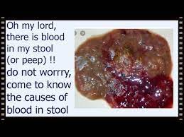 Seeing blood with your stools is just plain frightening, as this immediately brings to mind colon cancer. O My Lord Blood In My Stool Do Not Worry Come To Learn The Causes Of Blood In Stool Treatment Youtube
