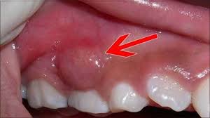 Điều trị áp-xe quanh răng cấp