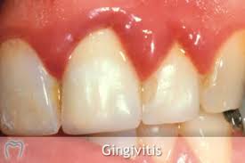 gum disease gingivitis periodonis