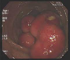 giant colonic lipoma arising from the