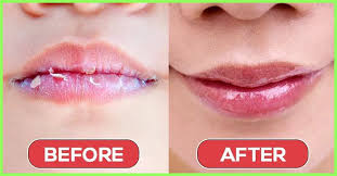 top 11 tips to get rid of chapped lips
