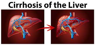 Cirrhosis is an advanced stage of scarring and damage of the liver. Diagram Showing Cirrhosis Of The Liver Download Free Vectors Clipart Graphics Vector Art
