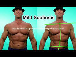 bodybuilding with scoliosis you