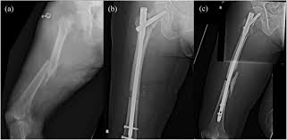 The winquist and hansen classification is a system of categorizing femoral shaft fractures based upon the degree of comminution.1. Ipsilateral Femoral Neck And Shaft Fractures Fixation With Proximal Femoral Nail Antirotation Ii Pfna Ii Technical Note And Cases Series Journal Of Orthopaedic Surgery And Research Full Text