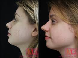 vbeam laser acne scars acne treatment