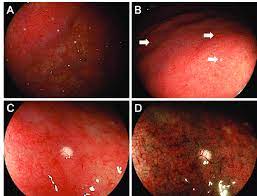 endoscopic images of case 1 multiple