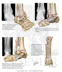 The fracture that occurs with this injury is higher up the leg than the ankle joint although much of the damage to the soft tissues is located around the ankle. Rotational Fracture Of Ankle Mortise