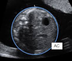 Ultrasound Scan Fetal Growth Scan Patient Information