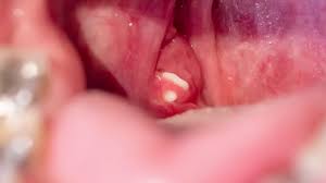 tonsil stones symptoms treatments
