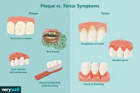 plaque vs tartar buildup removal