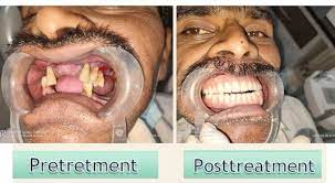 best dental implants in pune