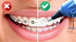 Getting braces for the first time expander with turning key making room for more teeth. 25 Brilliant Hacks To Get Hollywood Smile Videos Fltimes Com