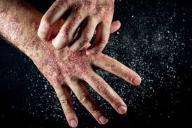 what causes eczema on your hands and