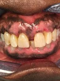 black gums dark gums loop perio