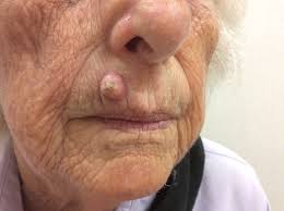 how skin cancer appears on lips