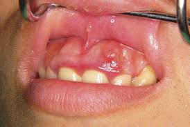 gingival squamous cell carcinoma