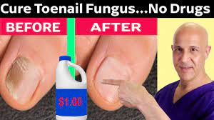 how to cure toenail fungus for pennies