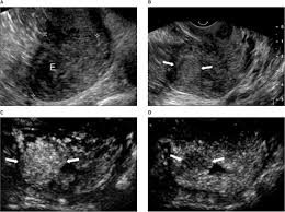 imaging of endometrial carcinoma using