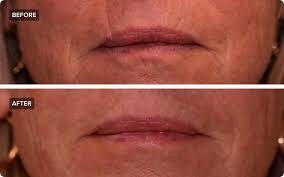 fat transfer to face procedure how