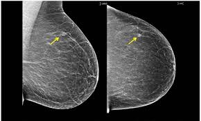 Revealed How Breast Density Is Key To Cancer Daily Mail
