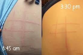 photos that show what dermatographism