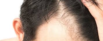 news does monistat work for hair loss