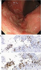 Infections are categorized based on the part of the body infected. Painful Proctitis With Mixed Infection Due To Herpes Simplex Virus Types 1 And 2 And Chlamydia Trachomatis International Journal Of Infectious Diseases