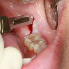 tooth extraction comprehensive guide
