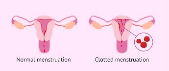blood clots occur during menstruation