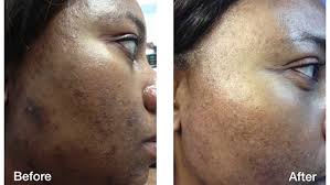 ··· chemical peel for face used for melasma & has effect on hyperpigmentation. Skin Of Color Skin Discoloration Seattle Washington Advanced Dermatology And Laser Institute Of Seattle