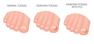 ingrown toenail removal cost 2023