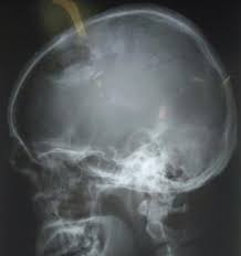 Sehingga fraktur servikal adalah terpisahnya kontinuitas tulang pada vertebra. Http Conference Unsyiah Ac Id Asup Ii Paper View 710 52