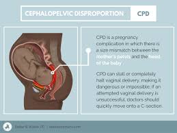 cephalopelvic disproportion cpd