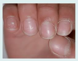 punctate leukonychia in the fingernails