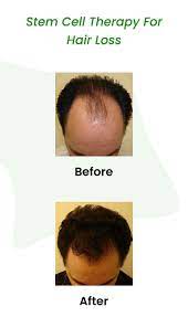 stem cell hair treatment revitalizing