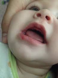 baby has weird p on her lip babycenter