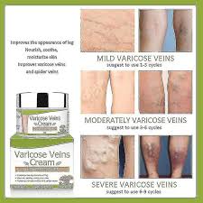 organic healing cream for varicose vein