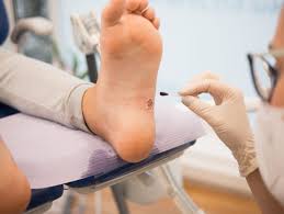 how to safely remove a foot wart at