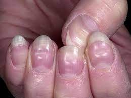 remove white spots from fingernails