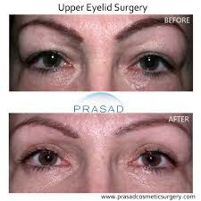 upper eyelid surgery