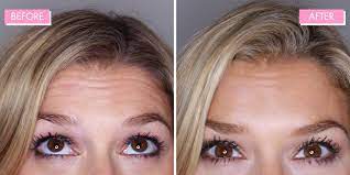 Injections for this small area generally need to be repeated every 3 to 4 months. Botox Review 9 Things You Need To Know Before Having It