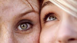veins under eyes causes treatment