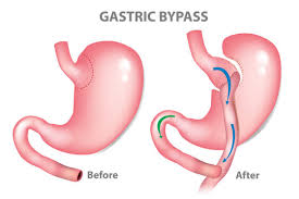 gastric byp images browse 802