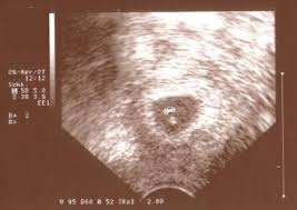 Ultraschall deines babys in der 8. Schwangerschaft 7 Woche 7 Ssw Ultraschallbilder
