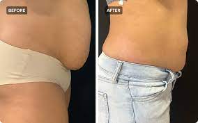 laser liposuction what is it how does